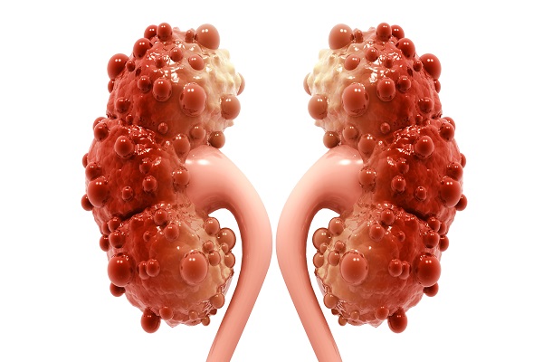 ayurvedic kidney treatment